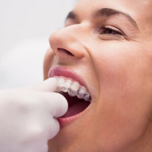 Orthodontics doctor placing clear aligners in patient mouth