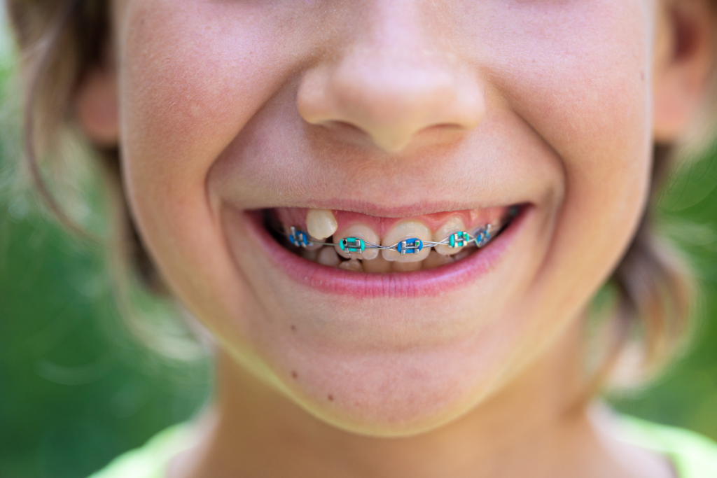 child with blue traditional metal braces